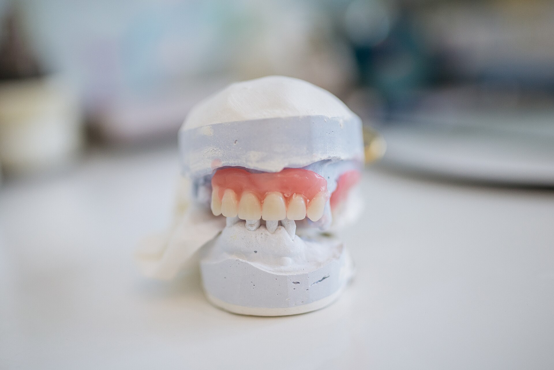 A dental model showing teeth and gum structure